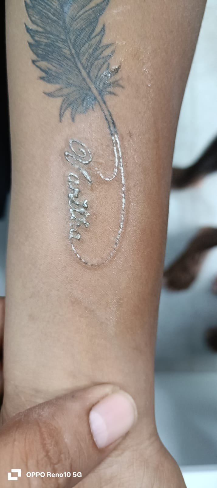 Picosecond Laser Tattoo Removal