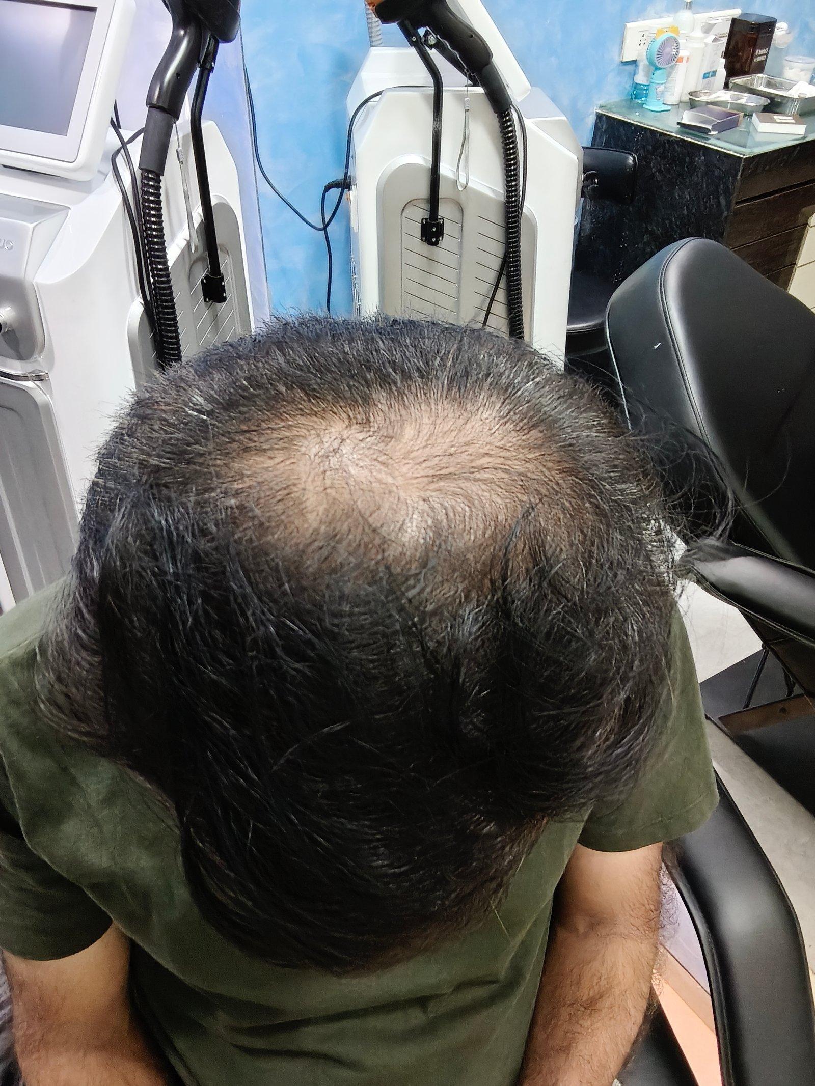 Advanced PRP / GFC Hair Restoration sub image