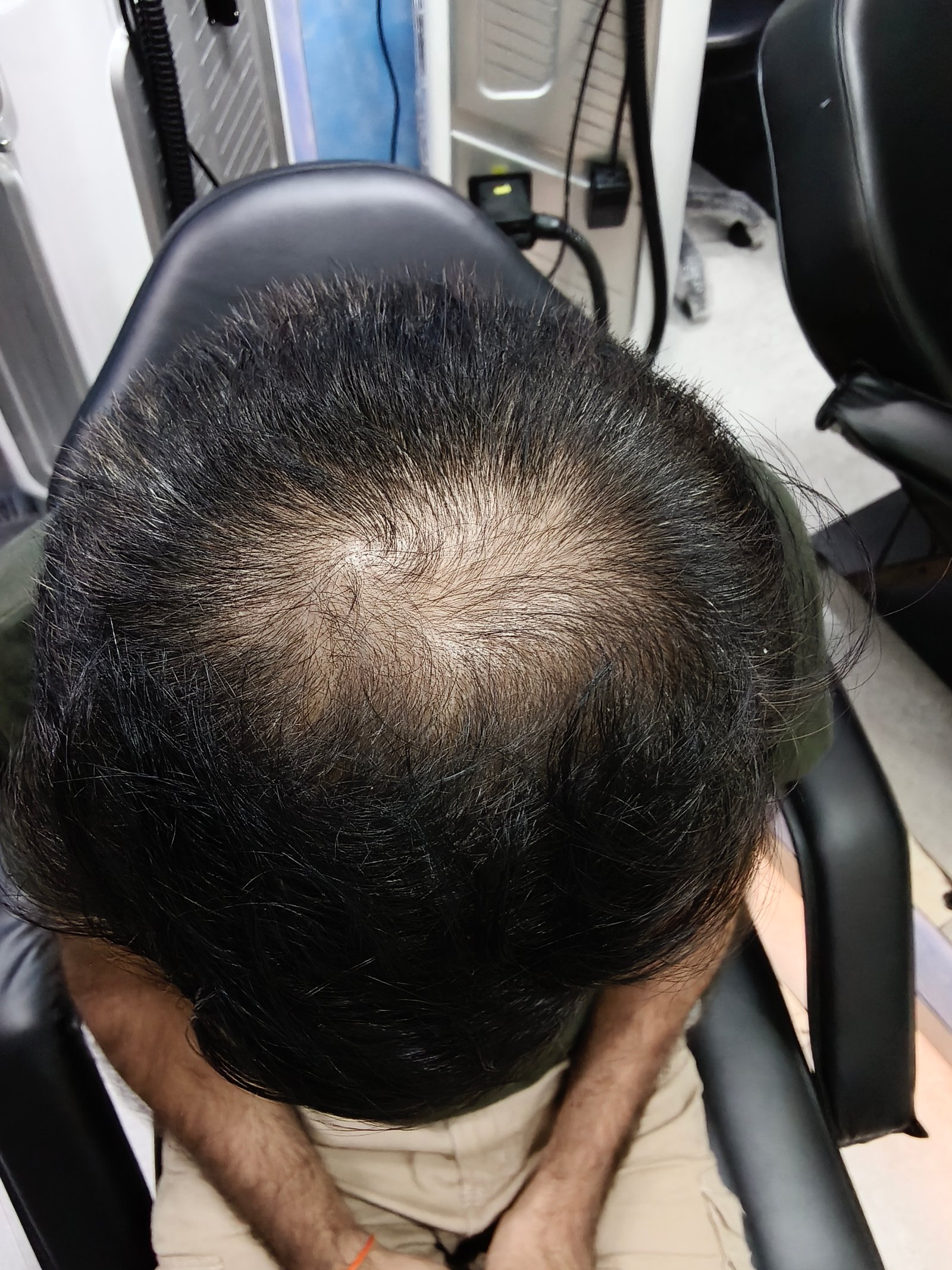 Advanced PRP / GFC Hair Restoration sub image